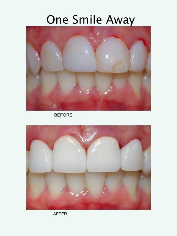 before and after example of dental crowns from One Smile Away