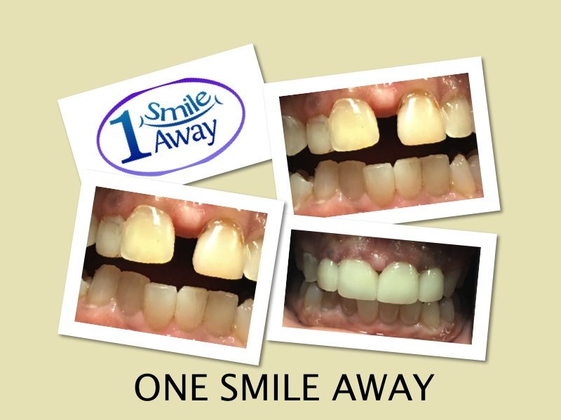 One Smile Away before and after dental crowns
