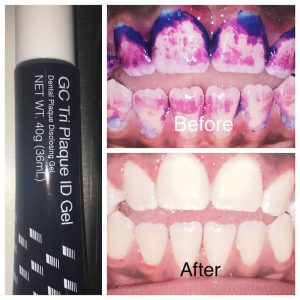 before and after teeth cleaning from One Smile Away