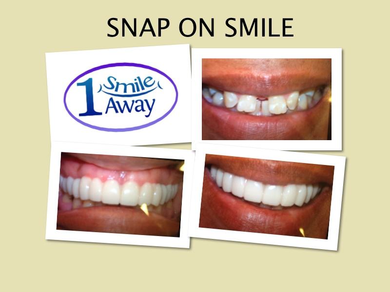 snap on smile showcase